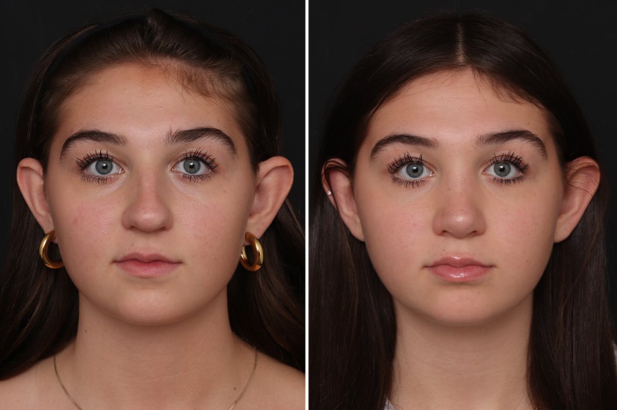 Rhinoplasty Before & After Gallery - Patient 340241 - Image 3