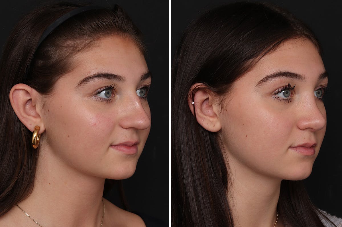 Rhinoplasty Before & After Gallery - Patient 340241 - Image 2