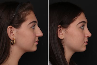 Rhinoplasty Before & After Gallery - Patient 340241 - Image 1