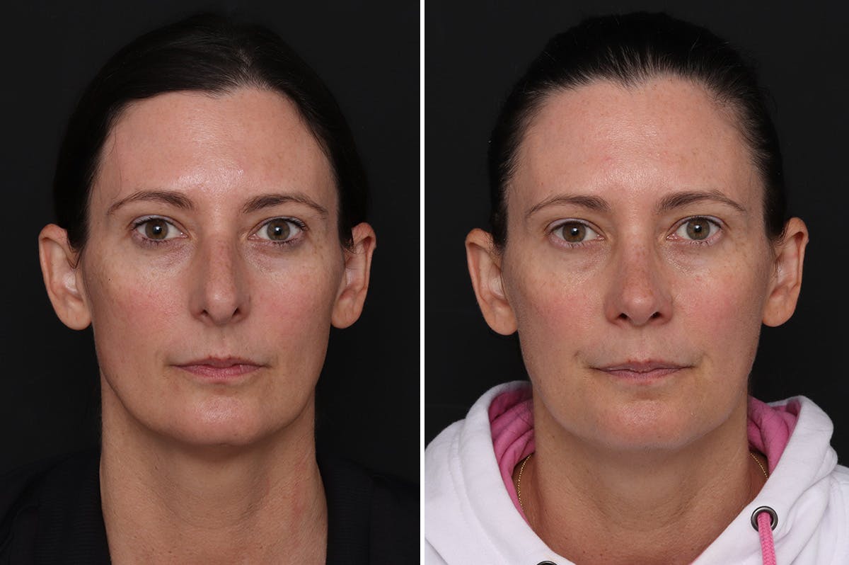 Rhinoplasty Before & After Gallery - Patient 409322 - Image 3