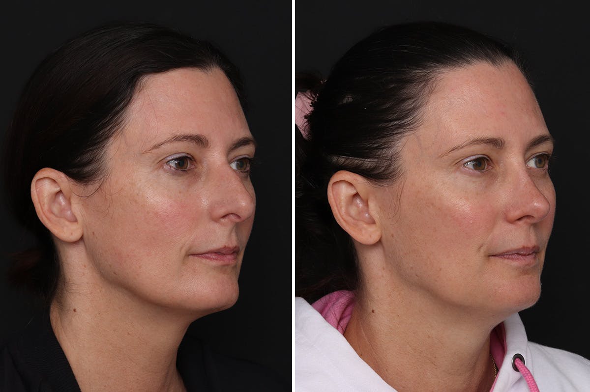 Rhinoplasty Before & After Gallery - Patient 409322 - Image 2