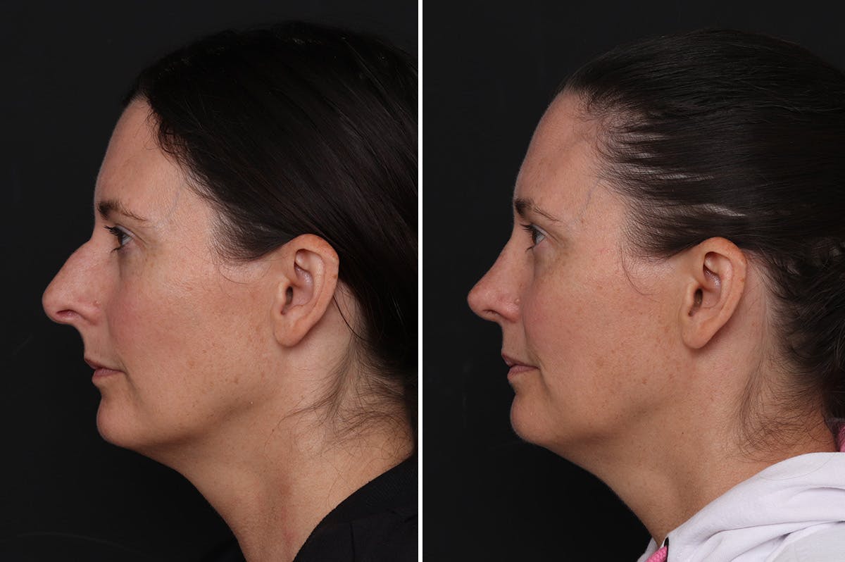 Rhinoplasty Before & After Gallery - Patient 409322 - Image 1