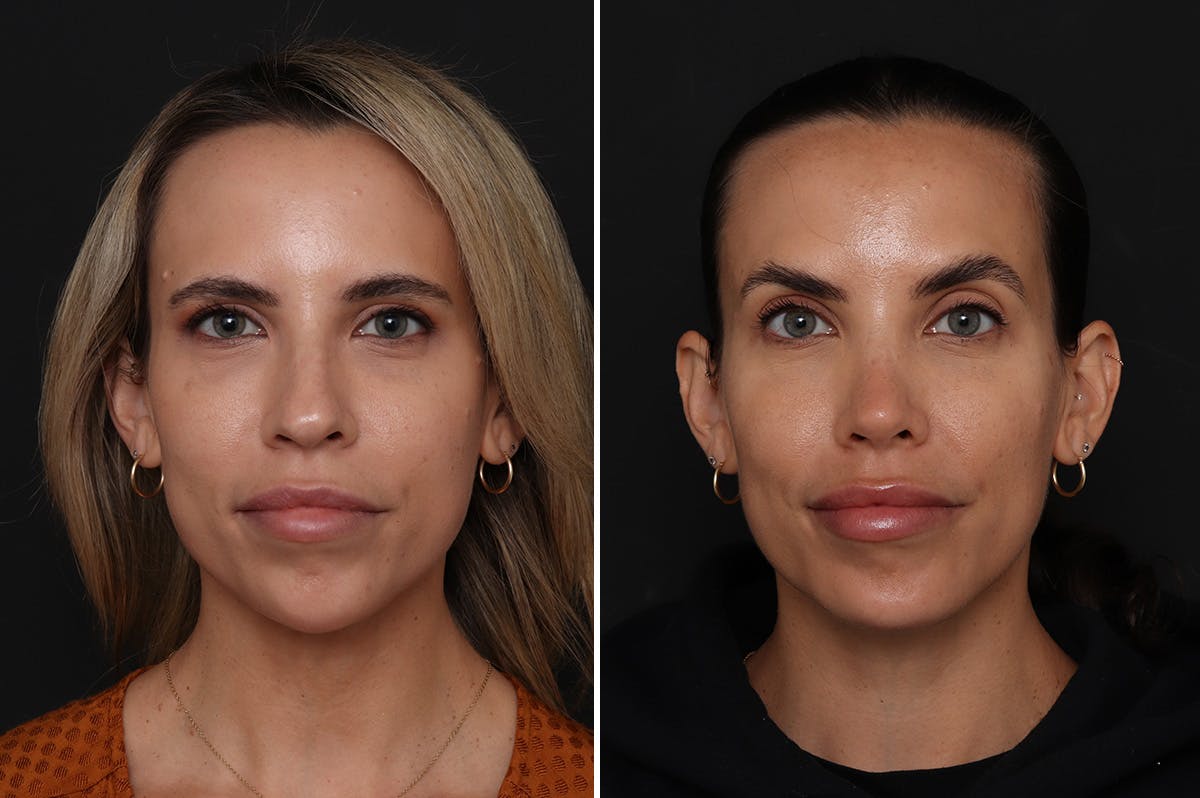 Chin Implants Before & After Gallery - Patient 174877 - Image 5