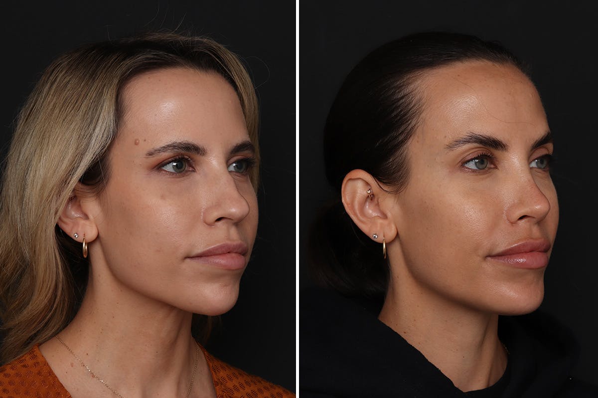 Chin Implants Before & After Gallery - Patient 174877 - Image 4