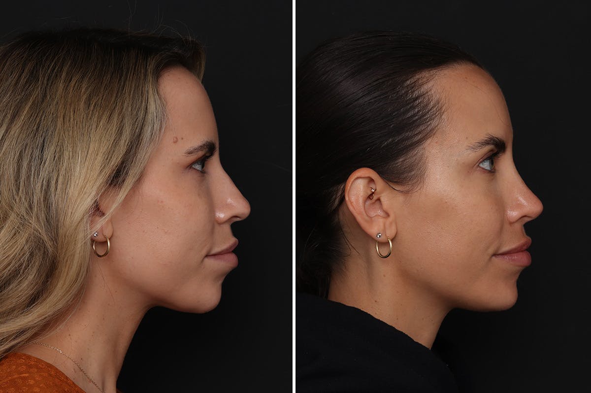 Chin Implants Before & After Gallery - Patient 174877 - Image 2