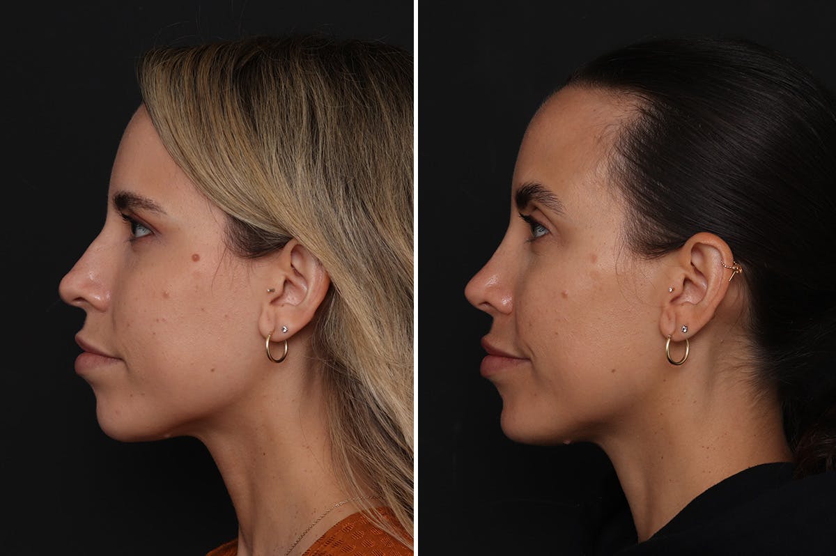 Chin Implants Before & After Gallery - Patient 174877 - Image 1