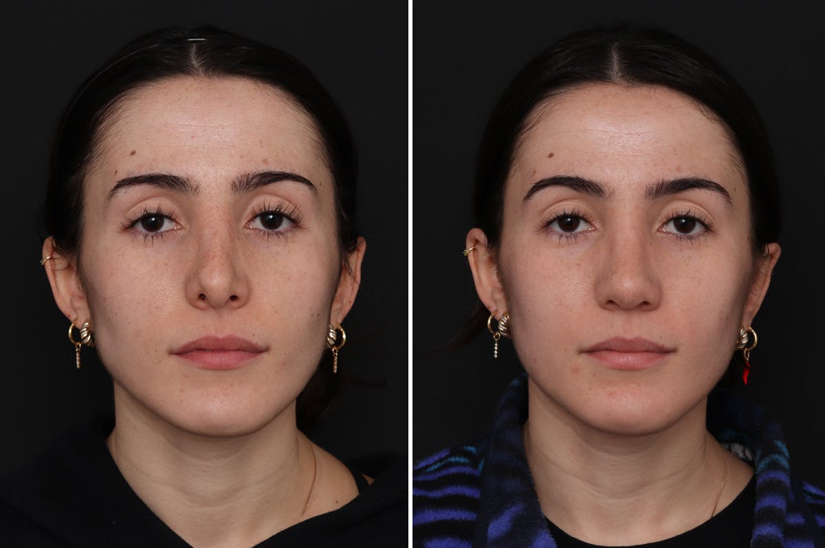 Revision Rhinoplasty Before & After Gallery - Patient 632840 - Image 3