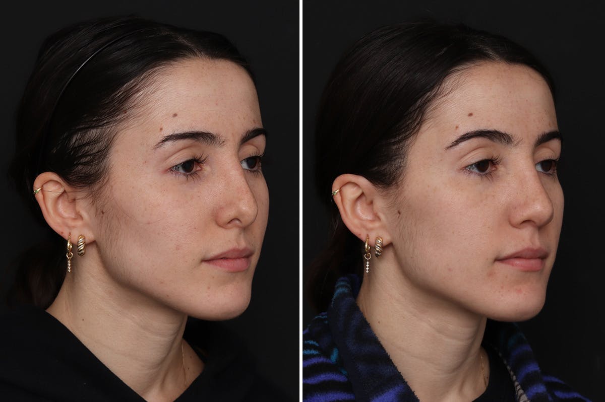 Revision Rhinoplasty Before & After Gallery - Patient 632840 - Image 2