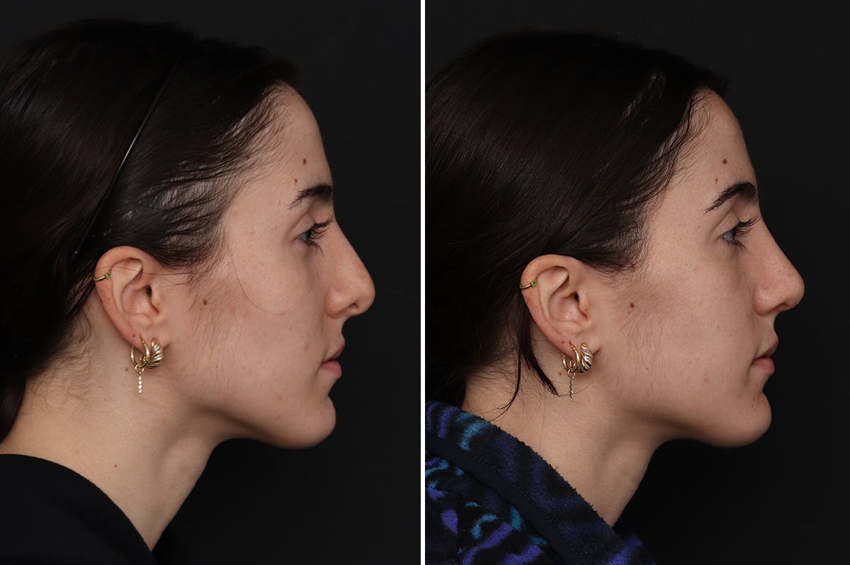Revision Rhinoplasty Before & After Gallery - Patient 632840 - Image 1