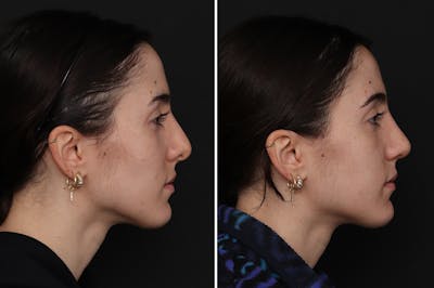 Revision Rhinoplasty Before & After Gallery - Patient 632840 - Image 1