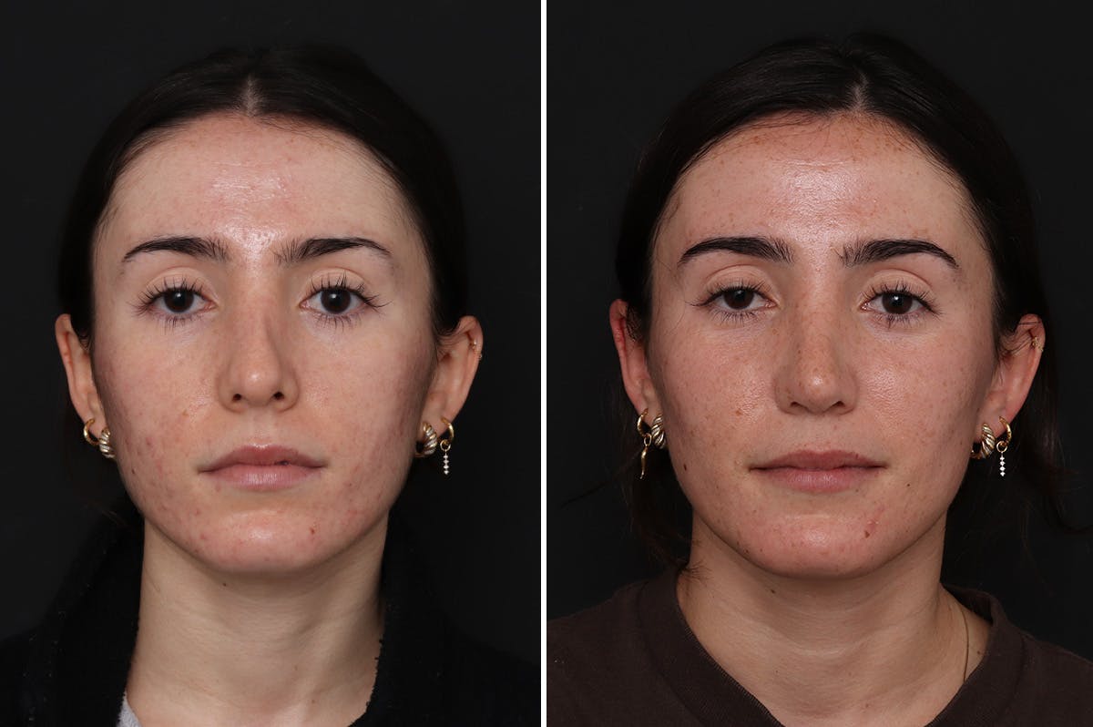 Revision Rhinoplasty Before & After Gallery - Patient 169117 - Image 3