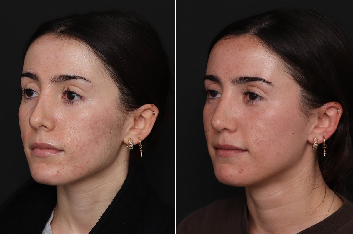 Revision Rhinoplasty Before & After Gallery - Patient 169117 - Image 2