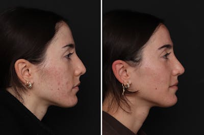 Revision Rhinoplasty Before & After Gallery - Patient 169117 - Image 1