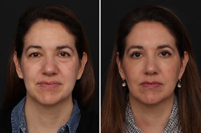Lower Eyelid Before & After Gallery - Patient 280844 - Image 1