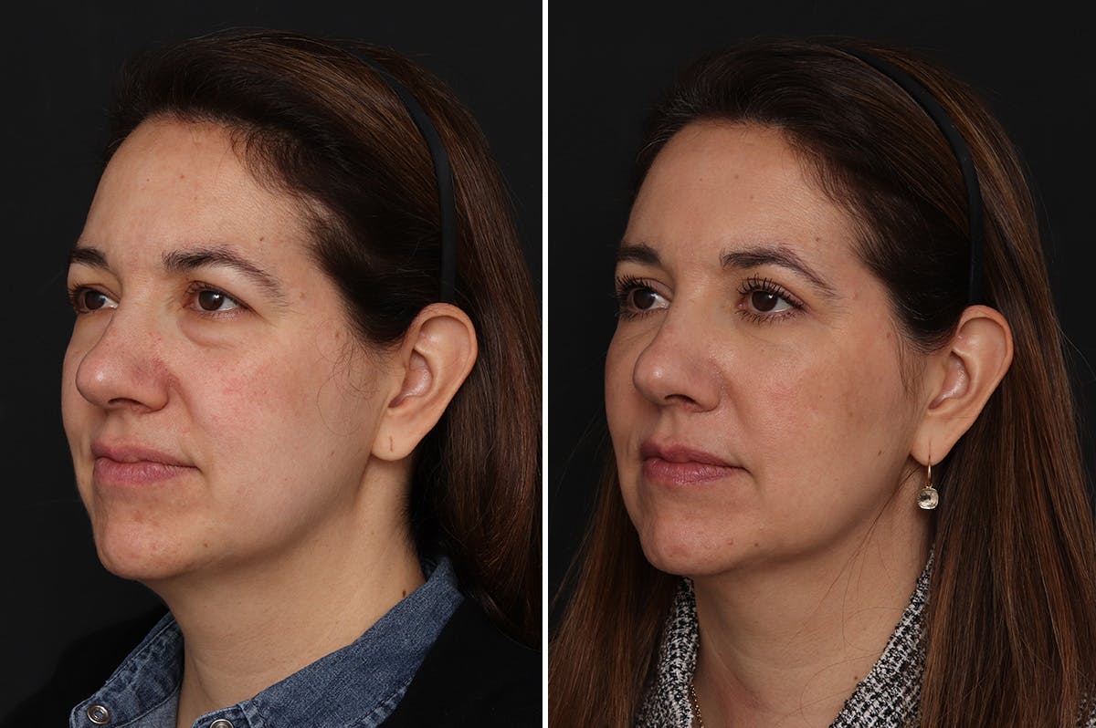 Lower Eyelid Before & After Gallery - Patient 280844 - Image 3