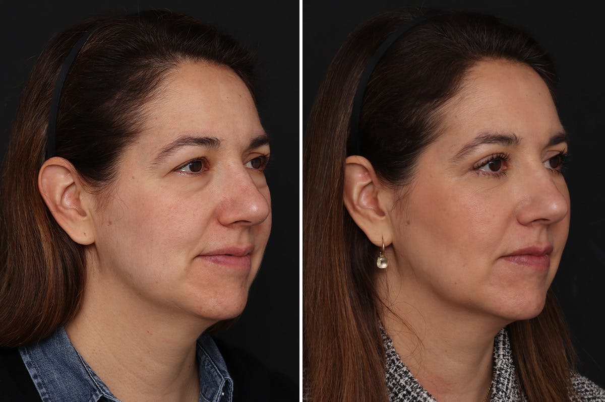 Lower Eyelid Before & After Gallery - Patient 280844 - Image 2