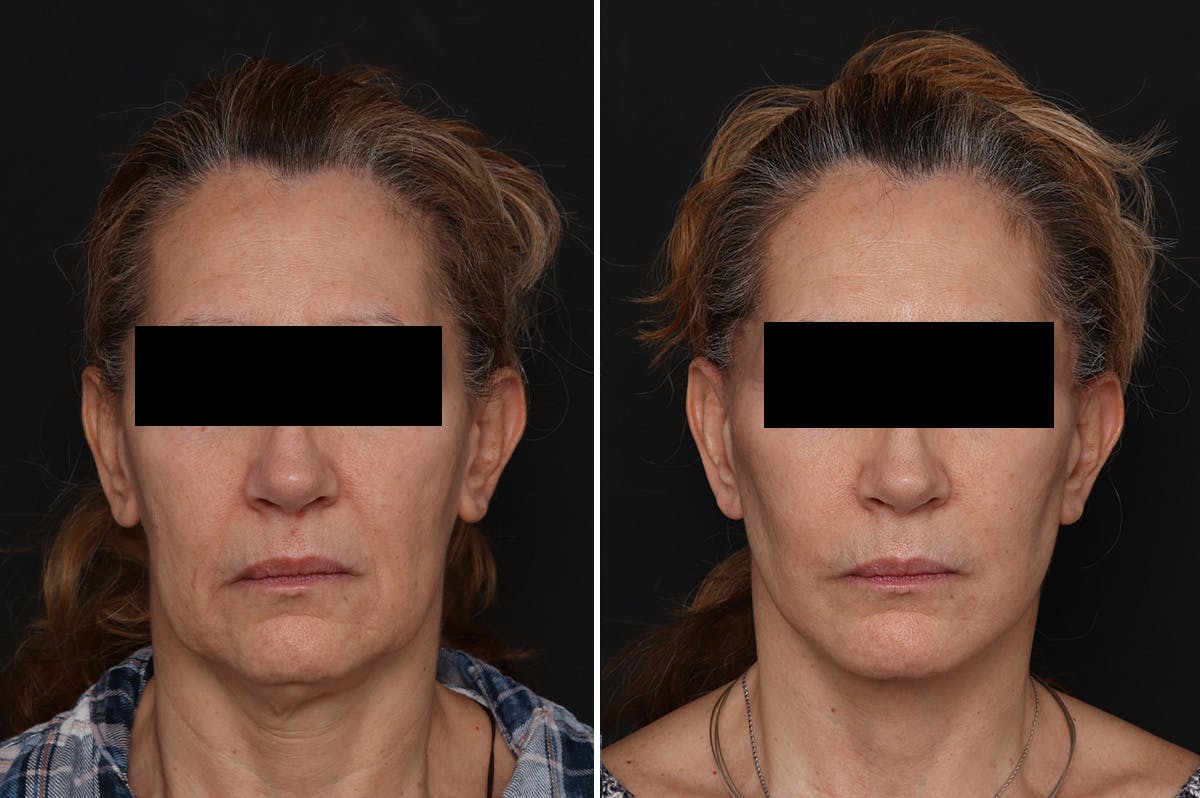 Facelift Before & After Gallery - Patient 217516 - Image 3