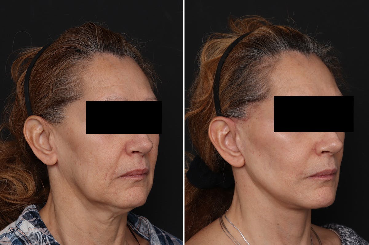 Facelift Before & After Gallery - Patient 217516 - Image 2