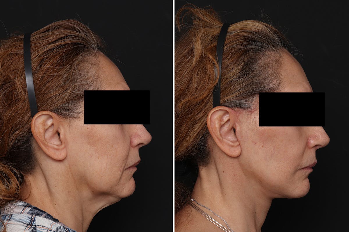 Facelift Before & After Gallery - Patient 217516 - Image 1