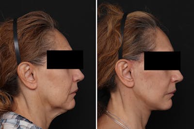 Facelift Before & After Gallery - Patient 217516 - Image 1
