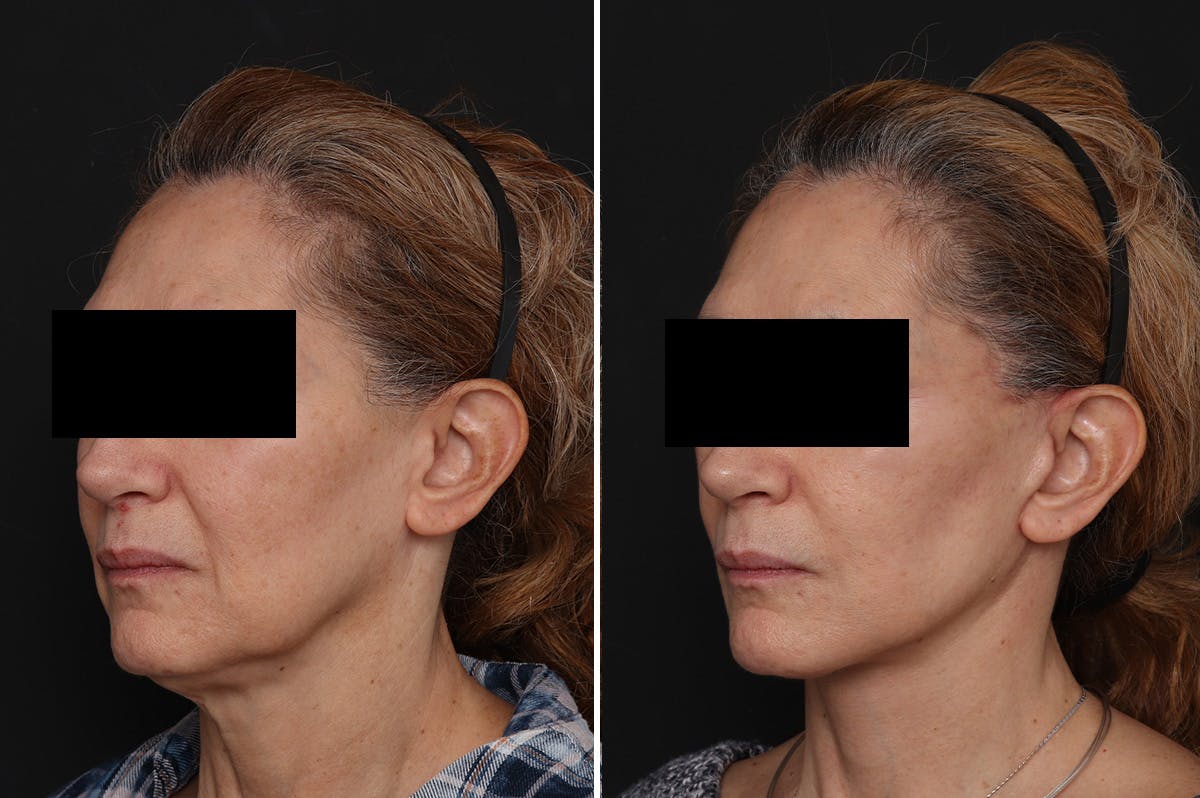 Facelift Before & After Gallery - Patient 217516 - Image 4