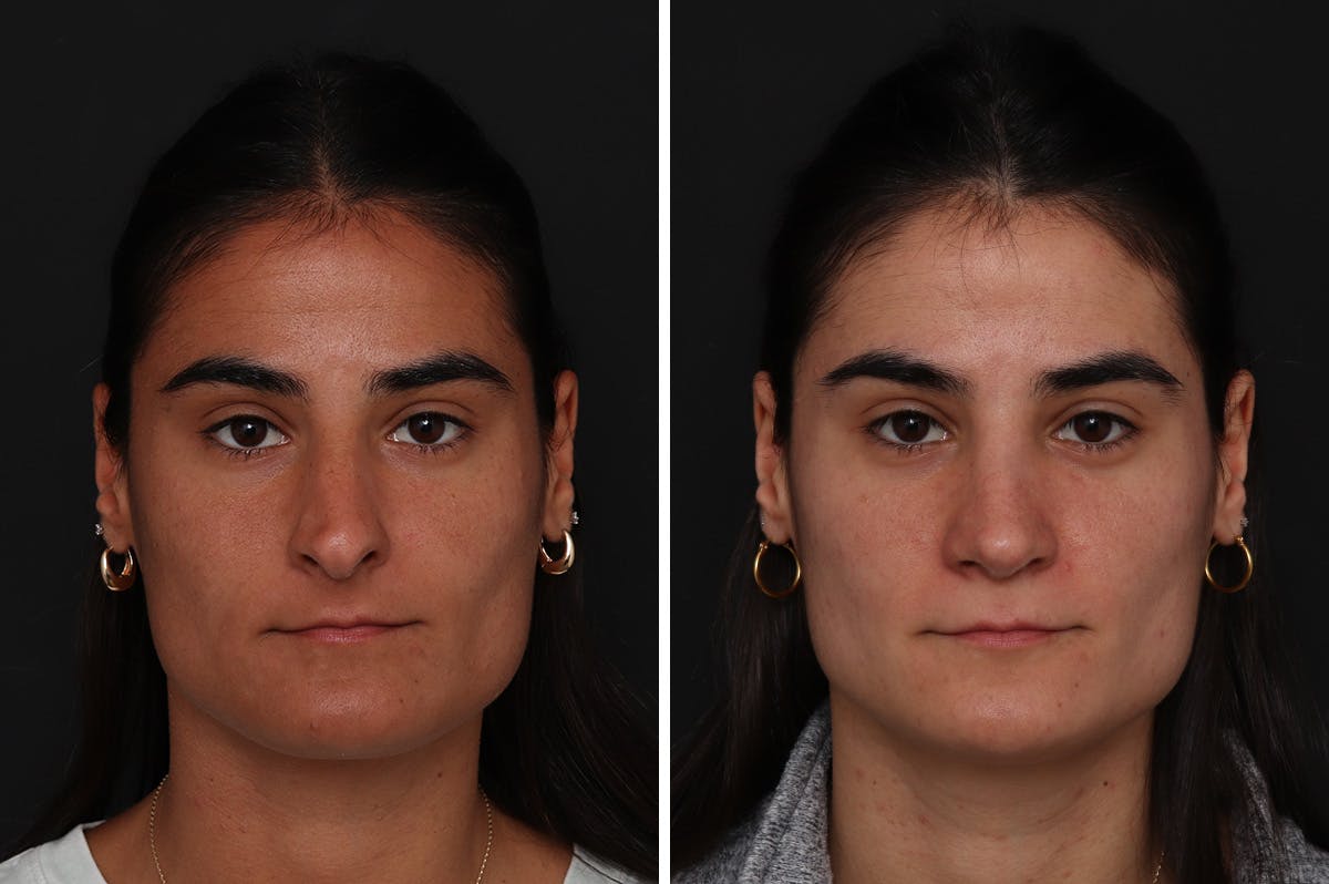 Rhinoplasty Before & After Gallery - Patient 365307 - Image 3