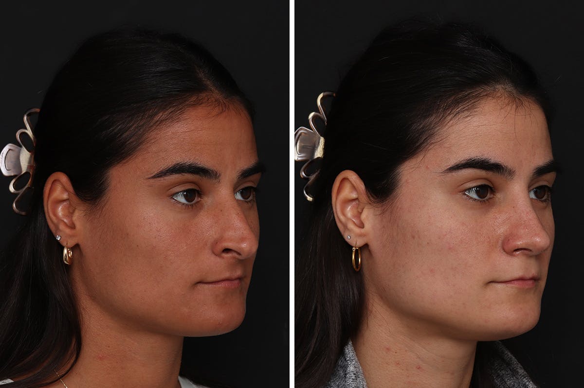 Rhinoplasty Before & After Gallery - Patient 365307 - Image 4