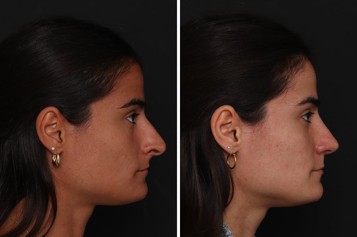 Rhinoplasty Before & After Gallery - Patient 365307 - Image 5