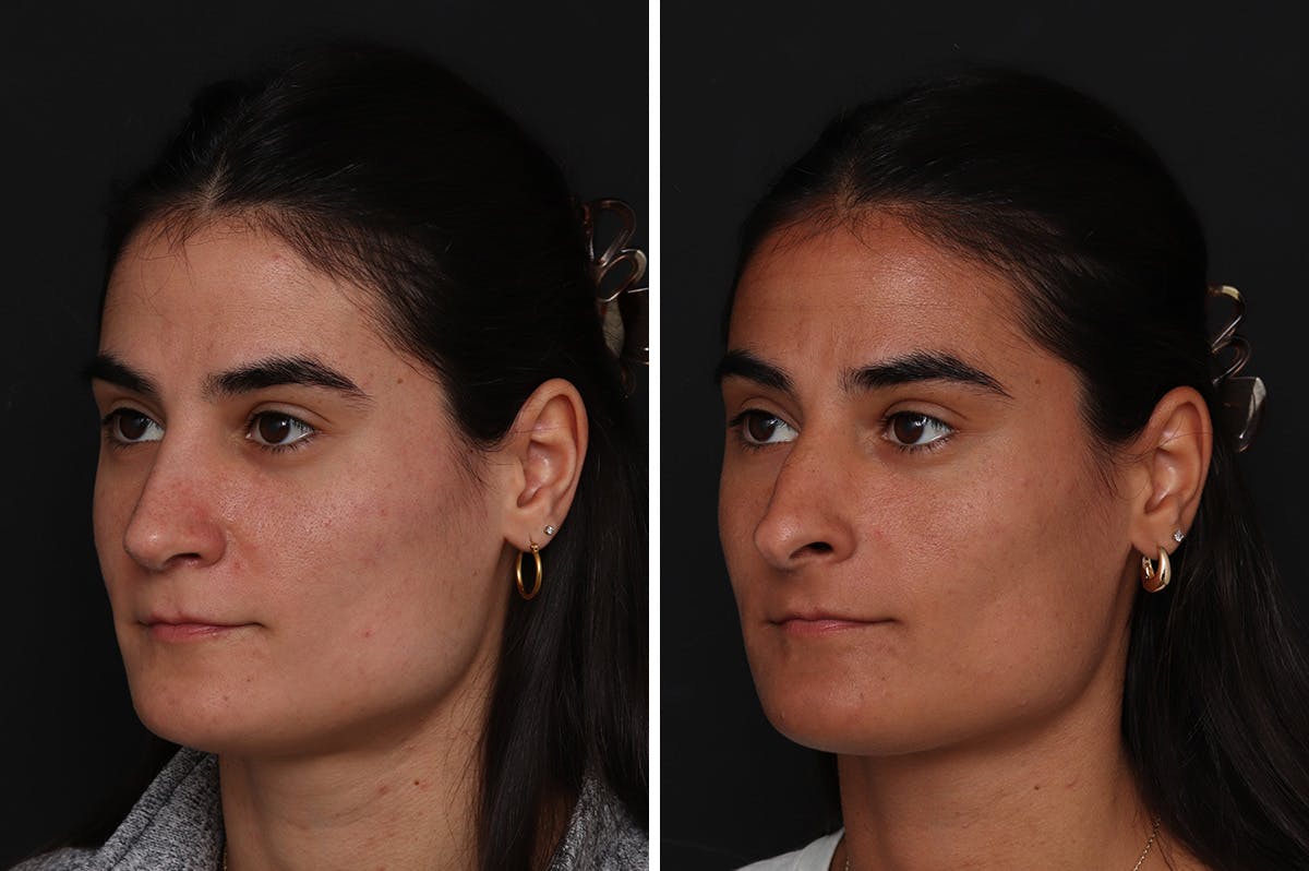 Rhinoplasty Before & After Gallery - Patient 365307 - Image 2