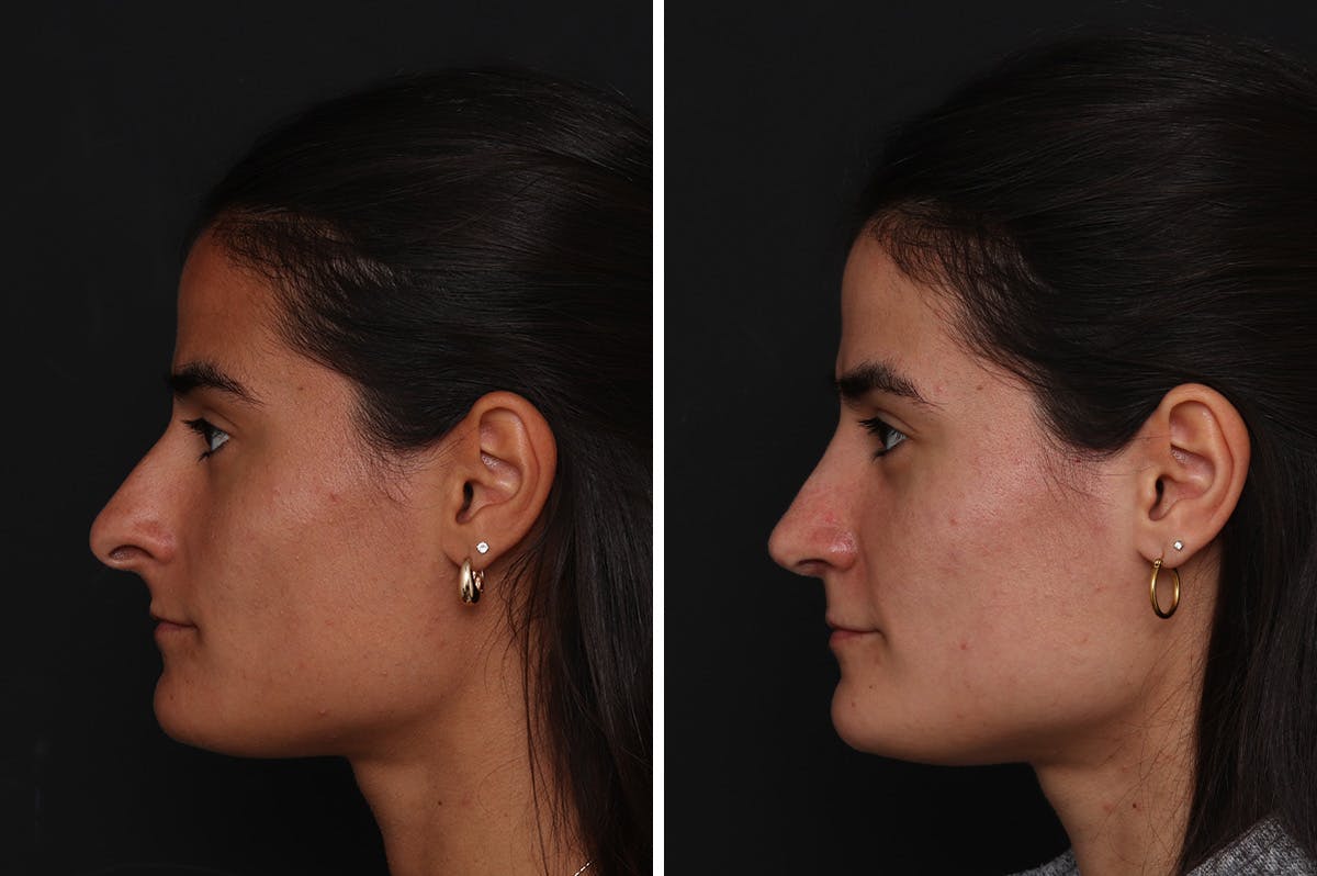 Rhinoplasty Before & After Gallery - Patient 365307 - Image 1