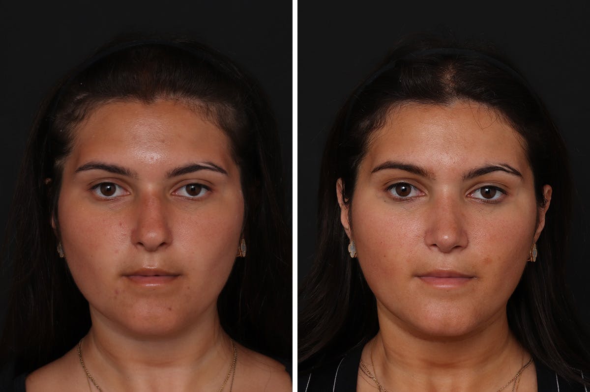 Rhinoplasty Before & After Gallery - Patient 276599 - Image 3