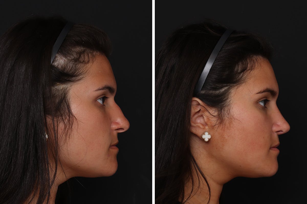 Rhinoplasty Before & After Gallery - Patient 276599 - Image 5