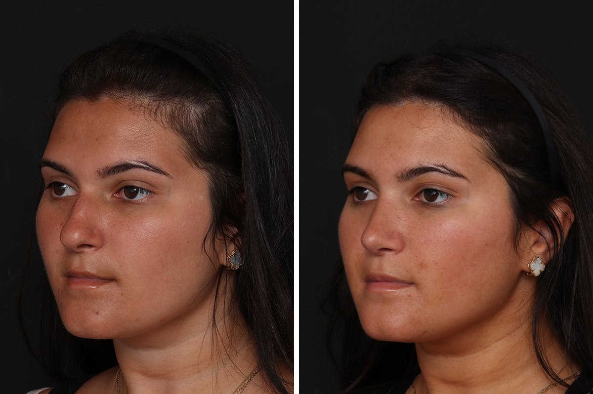 Rhinoplasty Before & After Gallery - Patient 276599 - Image 2