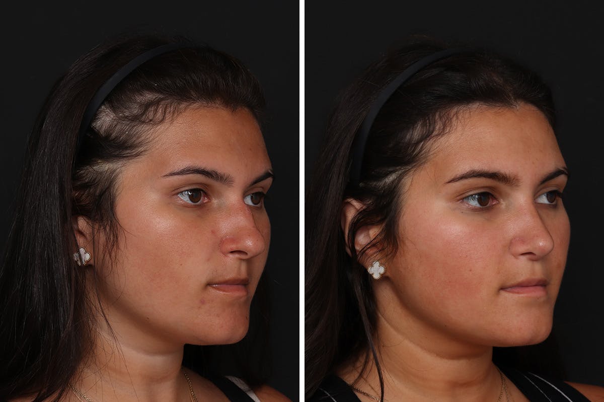 Rhinoplasty Before & After Gallery - Patient 276599 - Image 4