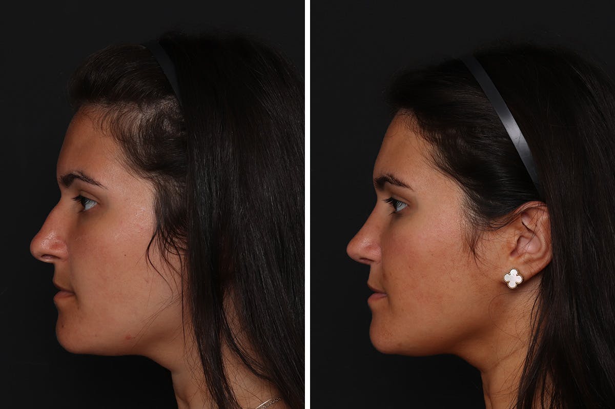 Rhinoplasty Before & After Gallery - Patient 276599 - Image 1