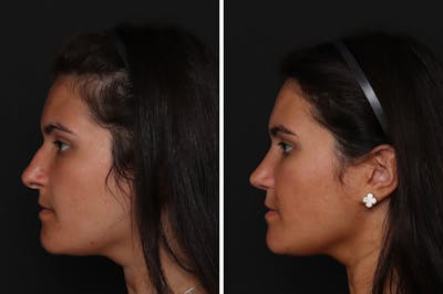 Rhinoplasty Before & After Gallery - Patient 276599 - Image 1