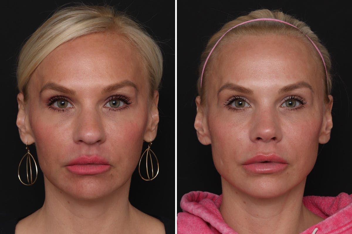 Rhinoplasty Before & After Gallery - Patient 198788 - Image 3