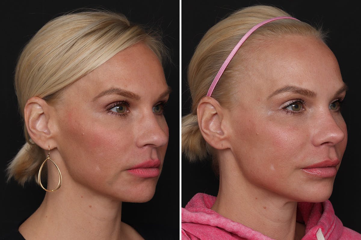 Rhinoplasty Before & After Gallery - Patient 198788 - Image 4