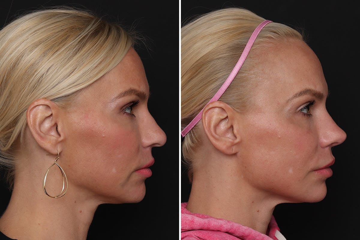 Rhinoplasty Before & After Gallery - Patient 198788 - Image 5