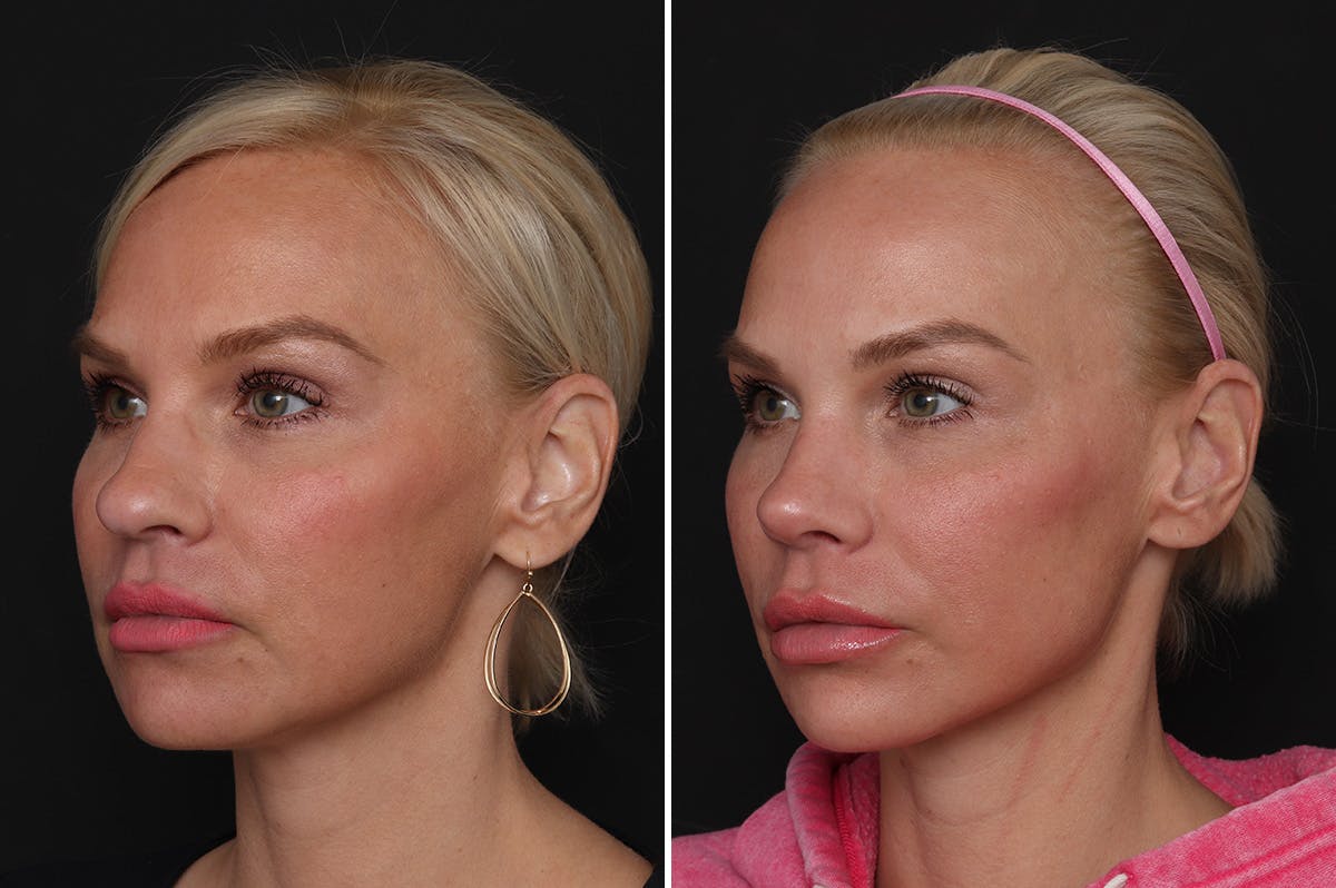 Rhinoplasty Before & After Gallery - Patient 198788 - Image 2