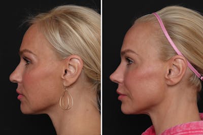 Rhinoplasty Before & After Gallery - Patient 198788 - Image 1