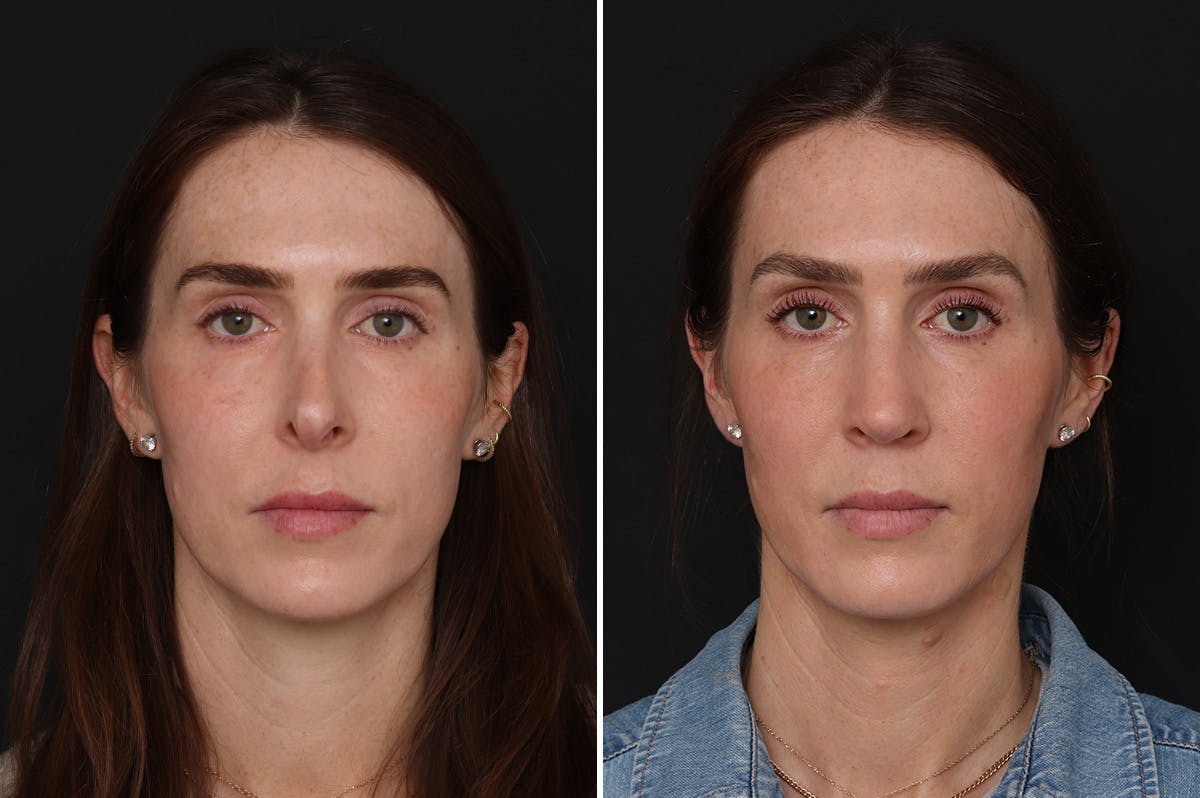 Revision Rhinoplasty Before & After Gallery - Patient 294602 - Image 3