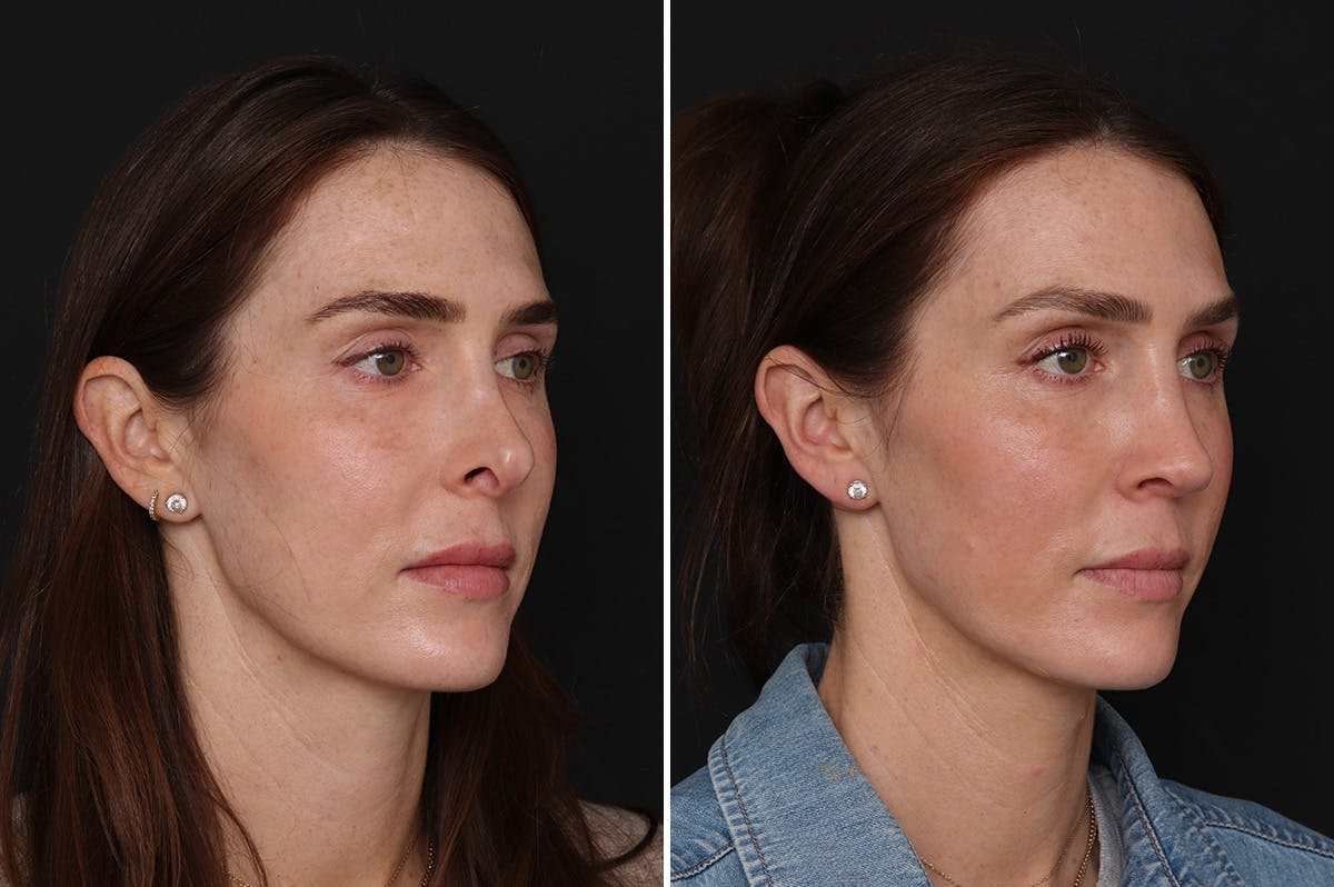 Revision Rhinoplasty Before & After Gallery - Patient 294602 - Image 4