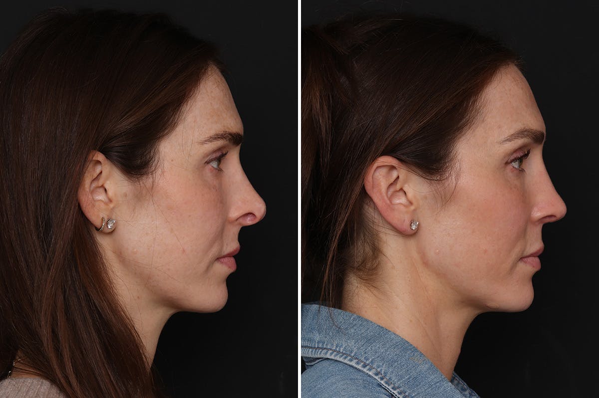 Revision Rhinoplasty Before & After Gallery - Patient 294602 - Image 5