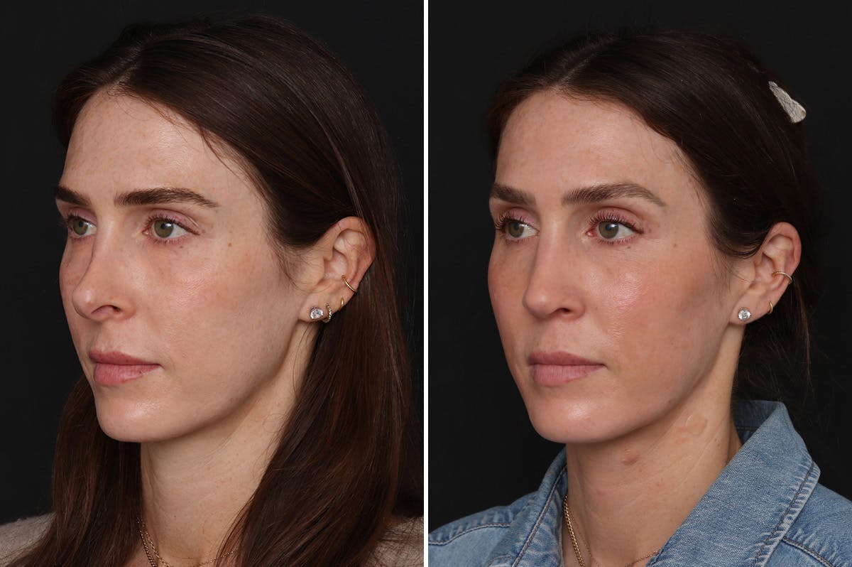 Revision Rhinoplasty Before & After Gallery - Patient 294602 - Image 2