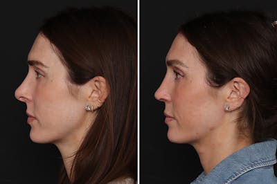 Revision Rhinoplasty Before & After Gallery - Patient 294602 - Image 1