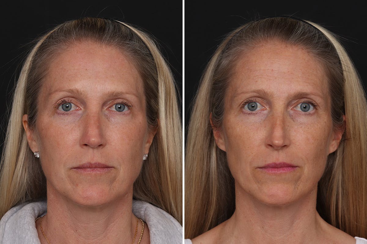 Revision Rhinoplasty Before & After Gallery - Patient 524398 - Image 3