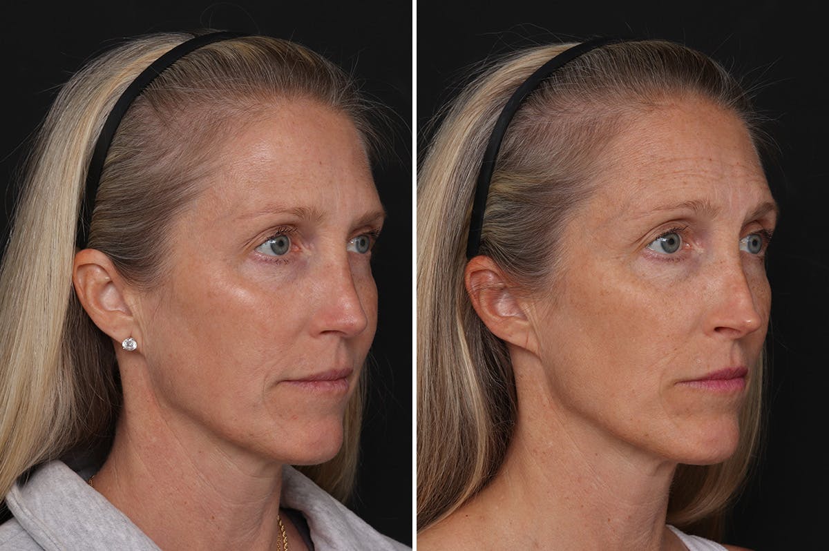 Revision Rhinoplasty Before & After Gallery - Patient 524398 - Image 4
