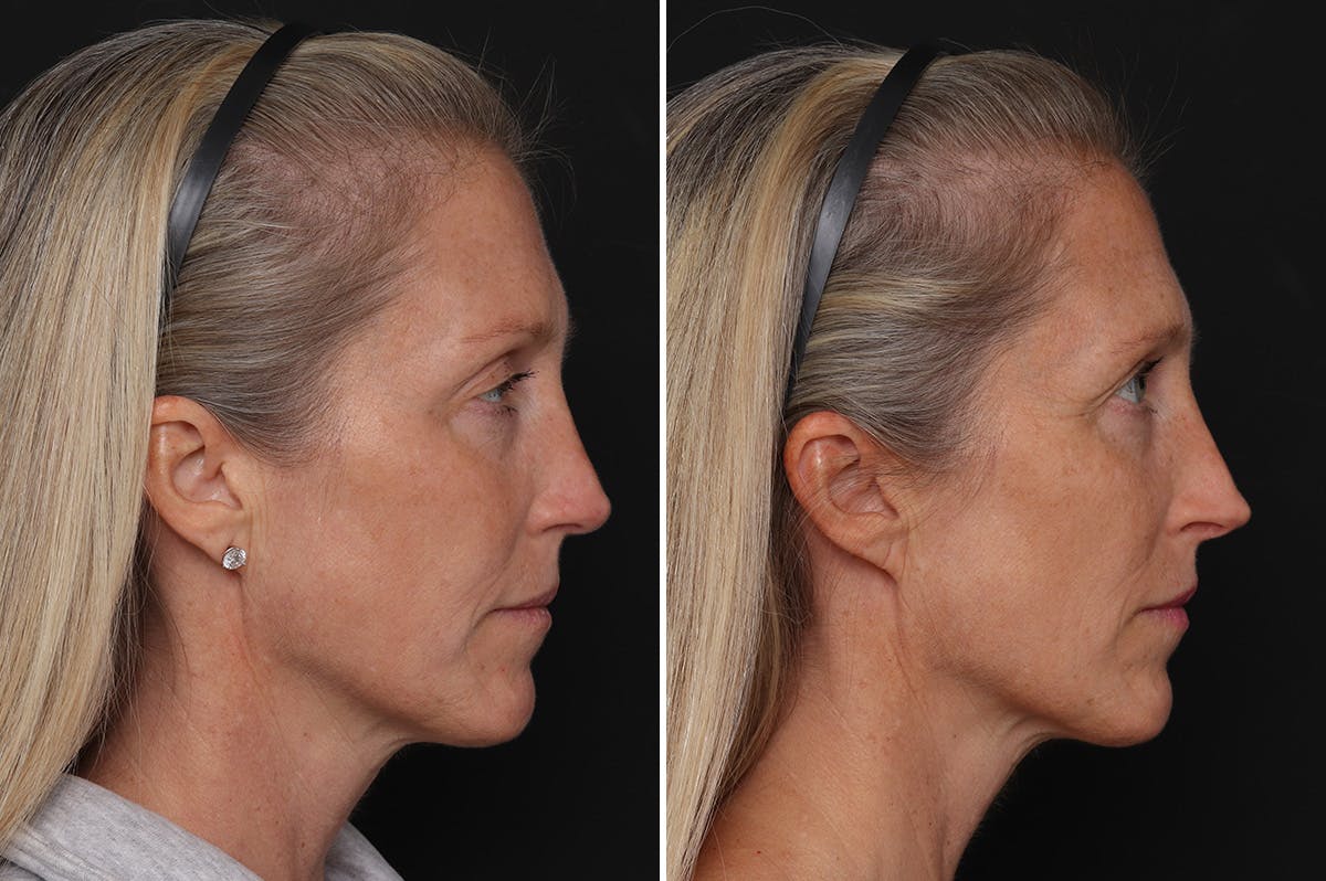 Revision Rhinoplasty Before & After Gallery - Patient 524398 - Image 5