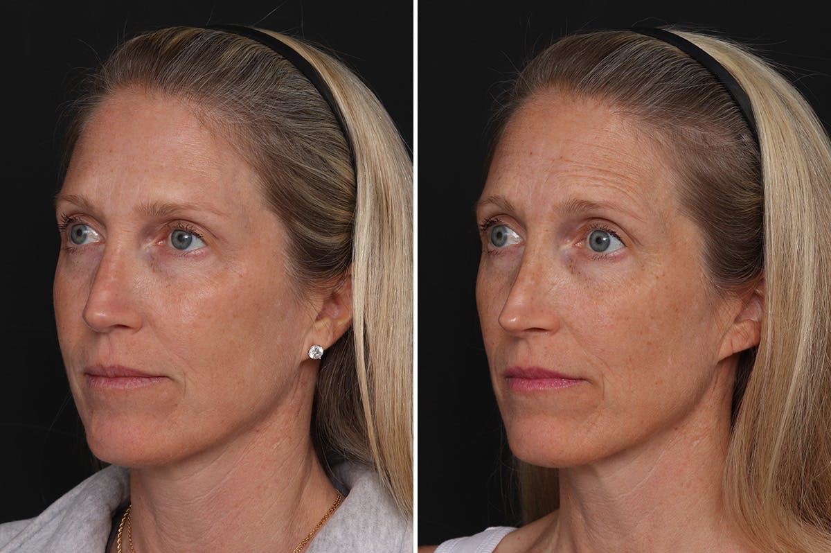 Revision Rhinoplasty Before & After Gallery - Patient 524398 - Image 2